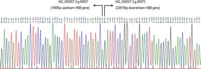 Molecular and hematological studies in a cohort of beta zero South East Asia deletion (β°-thal SEA) from Malaysian perspective